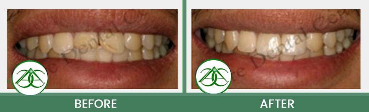 Tooth-Colored Fillings (Anterior and Posterior) at ABC Dental Center in Mountain View, CA