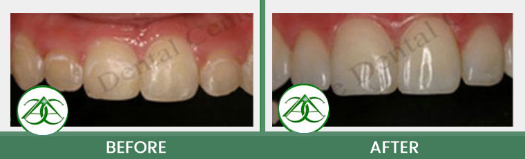 Tooth-Colored Fillings (Anterior and Posterior) at ABC Dental Center in Mountain View, CA