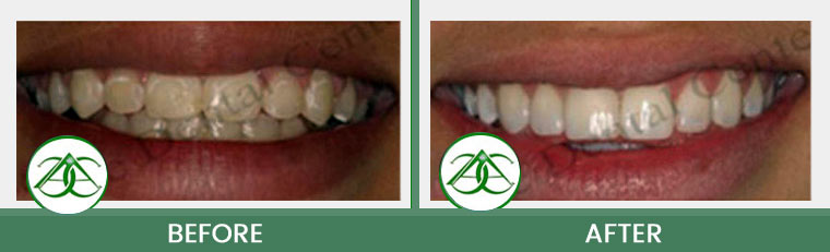 Tooth-Colored Fillings (Anterior and Posterior) at ABC Dental Center in Mountain View, CA