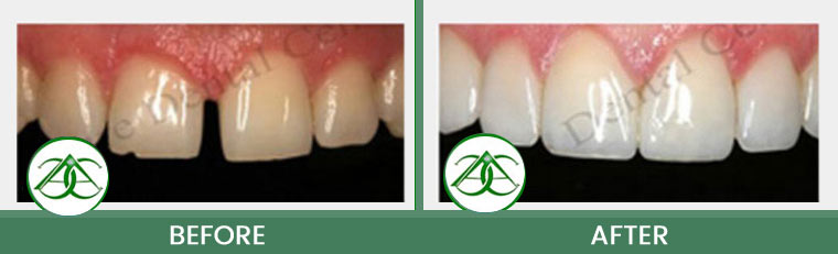 Tooth-Colored Fillings (Anterior and Posterior) at ABC Dental Center in Mountain View, CA