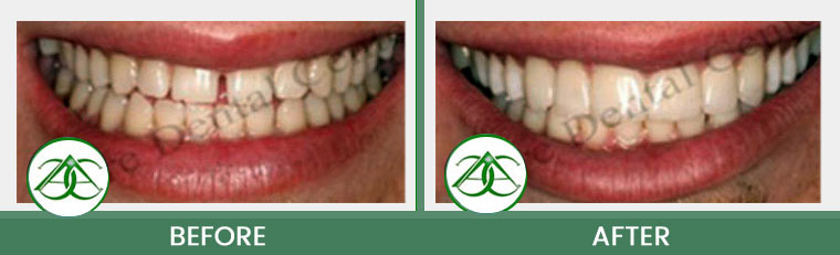 Tooth-Colored Fillings (Anterior and Posterior) at ABC Dental Center in Mountain View, CA