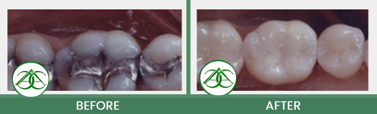 Tooth-Colored Fillings (Anterior and Posterior) at ABC Dental Center in Mountain View, CA