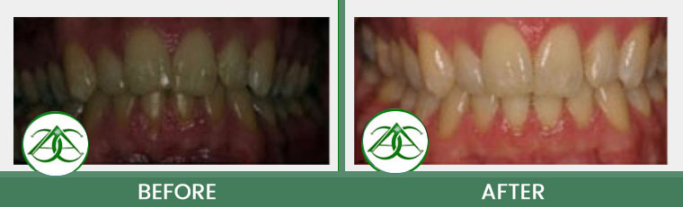 Tooth-Colored Fillings (Anterior and Posterior) at ABC Dental Center in Mountain View, CA