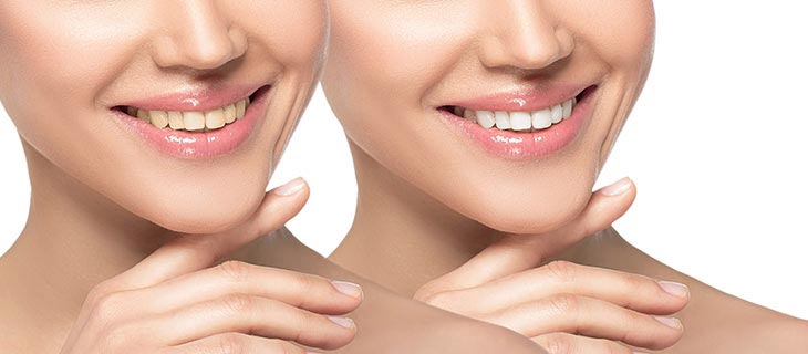 Yellow Teeth Treatment Options Near Me in Mountain View, CA