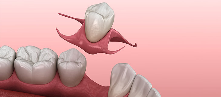Removable Partial Dentures Near Me in Mountain View, CA