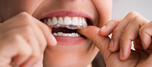 Invisalign Treatment Cost Without Insurance | Mountain View, CA