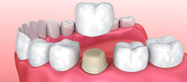 Everything You Need to Know About Getting a Dental Crown in Mountain View, CA