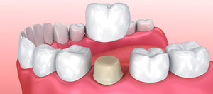 Everything You Need to Know About Getting a Dental Crown Near Me in Mountain View, CA