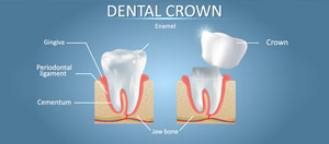 New Dental Crown Cost Near Me in Bay Area, Mountain View, CA